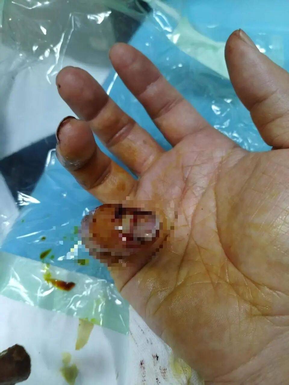 皇冠信用網在线注册_理发店主阻拦城管撕广告被咬伤手指皇冠信用網在线注册,警方:城管误认为商户阻拦行为是殴打,将调查处置